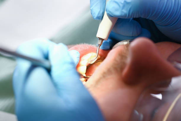 Best Emergency Treatment for Dental Infections or Abscesses in The Homesteads, TX